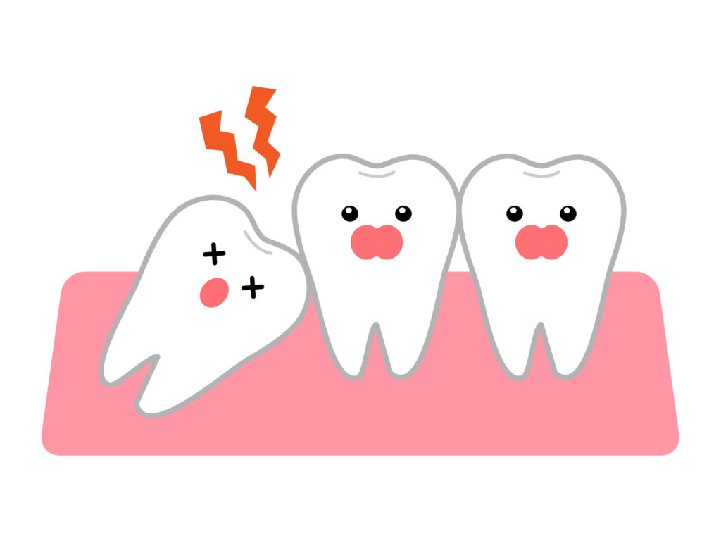 奥歯の奥に斜めに埋まっている親知らずと、その周囲に痛みが出ている様子を描いたイラスト